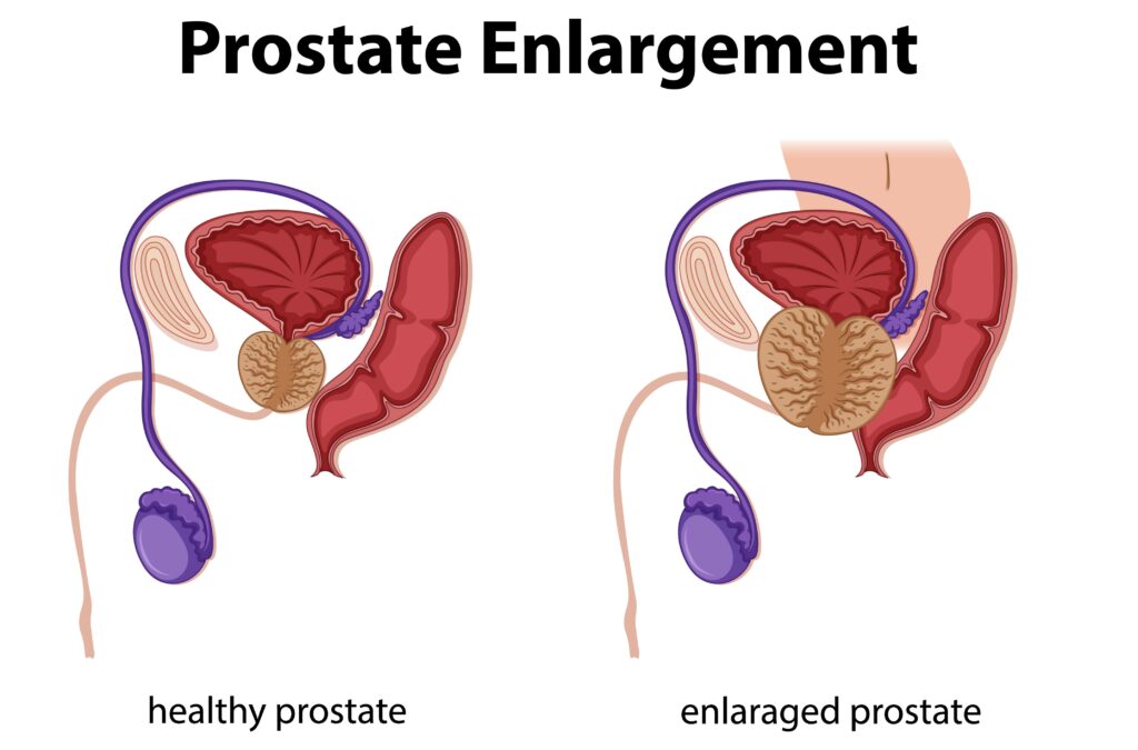 the difference between normal and BPH-affected prostates